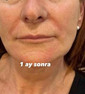 Moen yüz ve boyun güzellik cihazı fotoğraflı müşteri yorumu